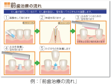 前歯治療の流れ